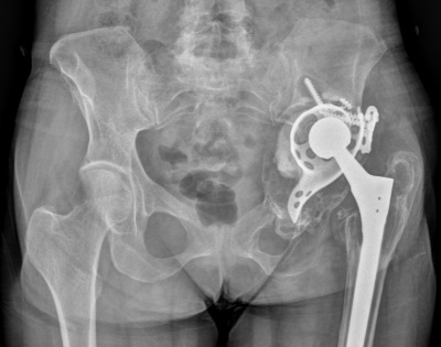 Fortis hospital conducts largest 3D printed hip implant in India | Fortis hospital conducts largest 3D printed hip implant in India