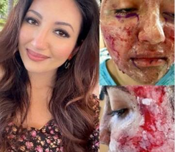 Indian-American Miss World 2021 first runner-up lives with pacemaker, survived facial burns | Indian-American Miss World 2021 first runner-up lives with pacemaker, survived facial burns Indian-American Miss World 2021 first runner-up lives with pacemaker, survived facial burns | Indian-American Miss World 2021 first runner-up lives with pacemaker, survived facial burns