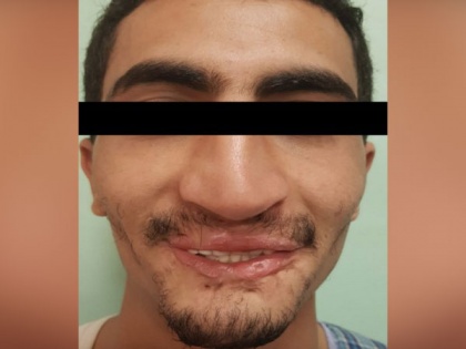Mobile blast in mouth injure Yemen youth, gets fresh lease of life with facial reconstruction surgery in India | Mobile blast in mouth injure Yemen youth, gets fresh lease of life with facial reconstruction surgery in India