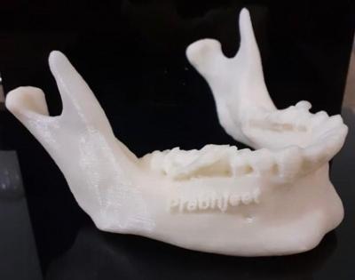 3D-printed jaw helps Indian oral cancer survivor eat everything | 3D-printed jaw helps Indian oral cancer survivor eat everything 3D-printed jaw helps Indian oral cancer survivor eat everything | 3D-printed jaw helps Indian oral cancer survivor eat everything