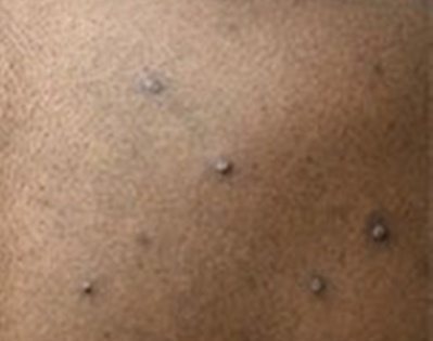 Monkeypox scare: Man in TN with skin rash kept in isolation | Monkeypox scare: Man in TN with skin rash kept in isolation