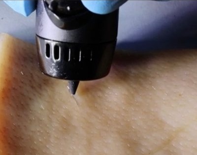 New wound-healing ink repairs cuts with a 3D-printing pen | New wound-healing ink repairs cuts with a 3D-printing pen