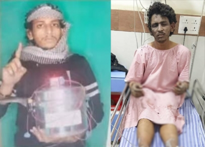 Mangaluru cooker blast case: Suspected terrorist discharged from hospital | Mangaluru cooker blast case: Suspected terrorist discharged from hospital