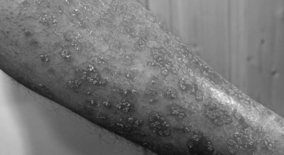 10-20pc women experience psoriasis during pregnancy: Experts | 10-20pc women experience psoriasis during pregnancy: Experts 10-20pc women experience psoriasis during pregnancy: Experts | 10-20pc women experience psoriasis during pregnancy: Experts