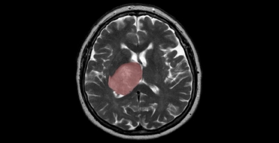 How virus infection is linked with progress of brain cancer | How virus infection is linked with progress of brain cancer