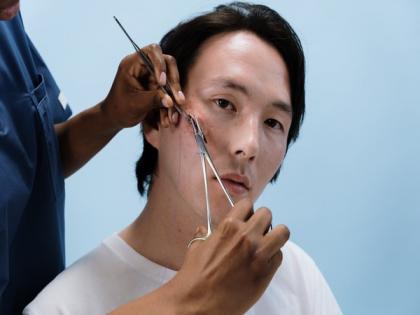 Microneedling improves appearance of surgical scars, especially when done early | Microneedling improves appearance of surgical scars, especially when done early