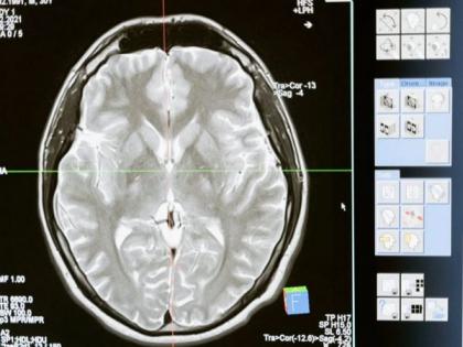 Silent synapses are abundant in the adult brain: Study | Silent synapses are abundant in the adult brain: Study