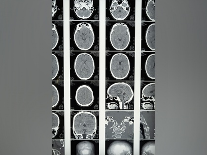 Researchers use MRI data to predict brain tumor progression | Researchers use MRI data to predict brain tumor progression