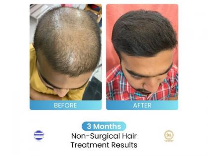 Dr Stuti Khare Shukla's Non-Surgical Hair Growth Booster helping multiple people suffering from Hair Loss Issues | Dr Stuti Khare Shukla's Non-Surgical Hair Growth Booster helping multiple people suffering from Hair Loss Issues
