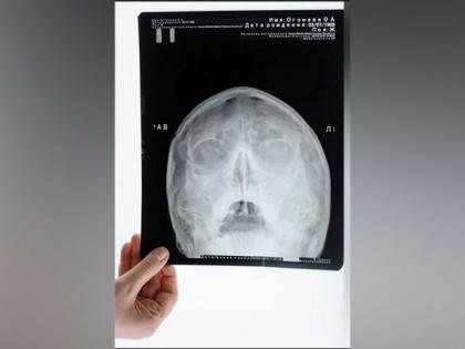 Study: Risk of skull fractures is higher in men than women | Study: Risk of skull fractures is higher in men than women