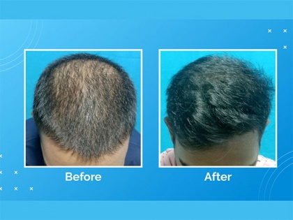 VCare's treatment for hair loss and hair thinning | VCare's treatment for hair loss and hair thinning