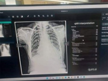 District Hospital Shopian becomes first in Kashmir division to introduce AI in radio diagnosis | District Hospital Shopian becomes first in Kashmir division to introduce AI in radio diagnosis