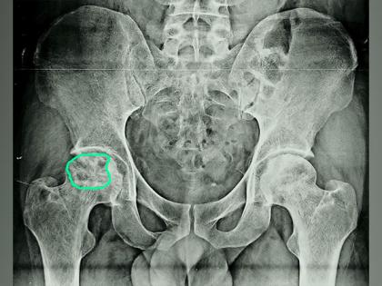Hip-Related Complications Highly Prevalent Among Youngsters Due to Excess Steroid Use | Hip-Related Complications Highly Prevalent Among Youngsters Due to Excess Steroid Use Hip-Related Complications Highly Prevalent Among Youngsters Due to Excess Steroid Use | Hip-Related Complications Highly Prevalent Among Youngsters Due to Excess Steroid Use