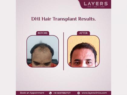 Layers, A Hair Transplant Clinic in Hyderabad, Implements Direct Hair Implantation (DHI) To Help Its Clients Tackle Premature Baldness | Layers, A Hair Transplant Clinic in Hyderabad, Implements Direct Hair Implantation (DHI) To Help Its Clients Tackle Premature Baldness Layers, A Hair Transplant Clinic in Hyderabad, Implements Direct Hair Implantation (DHI) To Help Its Clients Tackle Premature Baldness | Layers, A Hair Transplant Clinic in Hyderabad, Implements Direct Hair Implantation (DHI) To Help Its Clients Tackle Premature Baldness