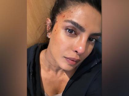 Priyanka Chopra shares photo of bloodied forehead from 'Heads of State' set | Priyanka Chopra shares photo of bloodied forehead from 'Heads of State' set Priyanka Chopra shares photo of bloodied forehead from 'Heads of State' set | Priyanka Chopra shares photo of bloodied forehead from 'Heads of State' set