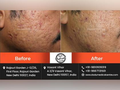What are the Benefits of Laser Treatment for Acne Scars? | What are the Benefits of Laser Treatment for Acne Scars? What are the Benefits of Laser Treatment for Acne Scars? | What are the Benefits of Laser Treatment for Acne Scars?