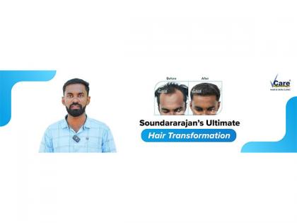 Reversing baldness with VCare | Reversing baldness with VCare Reversing baldness with VCare | Reversing baldness with VCare