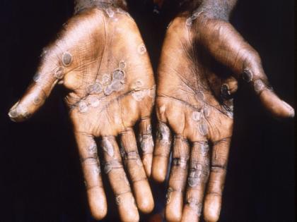 Sweden reports first case of contagious mpox strain outside Africa | Sweden reports first case of contagious mpox strain outside Africa Sweden reports first case of contagious mpox strain outside Africa | Sweden reports first case of contagious mpox strain outside Africa