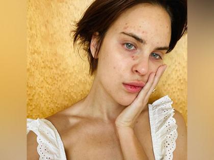 Tallulah Willis opens up about her struggles with skin-picking disorder | Tallulah Willis opens up about her struggles with skin-picking disorder Tallulah Willis opens up about her struggles with skin-picking disorder | Tallulah Willis opens up about her struggles with skin-picking disorder
