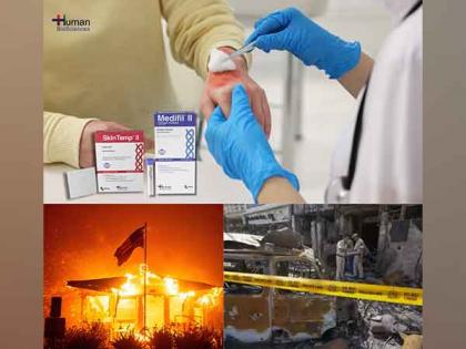 Human BioSciences Addresses the Global Burn Crisis with Advanced Wound Care Solutions | Human BioSciences Addresses the Global Burn Crisis with Advanced Wound Care Solutions Human BioSciences Addresses the Global Burn Crisis with Advanced Wound Care Solutions | Human BioSciences Addresses the Global Burn Crisis with Advanced Wound Care Solutions