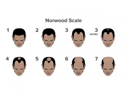 What is Causing Your Hair Fall? Take This Scientifically Backed Hair Loss Quiz | What is Causing Your Hair Fall? Take This Scientifically Backed Hair Loss Quiz What is Causing Your Hair Fall? Take This Scientifically Backed Hair Loss Quiz | What is Causing Your Hair Fall? Take This Scientifically Backed Hair Loss Quiz