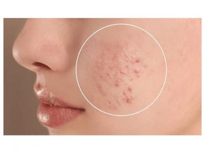 How to Treat Acne and Pigmentation? | How to Treat Acne and Pigmentation? How to Treat Acne and Pigmentation? | How to Treat Acne and Pigmentation?