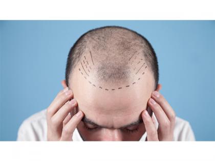 Dermatologist vs. Hair Transplant Surgeon: Who's Best for Hair Transplant Surgery? | Dermatologist vs. Hair Transplant Surgeon: Who's Best for Hair Transplant Surgery? Dermatologist vs. Hair Transplant Surgeon: Who's Best for Hair Transplant Surgery? | Dermatologist vs. Hair Transplant Surgeon: Who's Best for Hair Transplant Surgery?