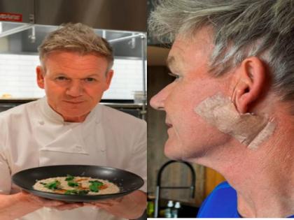 Gordon Ramsay reveals undergoing surgery for skin cancer, cautions "don't forget your sunscreen" | Gordon Ramsay reveals undergoing surgery for skin cancer, cautions "don't forget your sunscreen" Gordon Ramsay reveals undergoing surgery for skin cancer, cautions "don't forget your sunscreen" | Gordon Ramsay reveals undergoing surgery for skin cancer, cautions "don't forget your sunscreen"