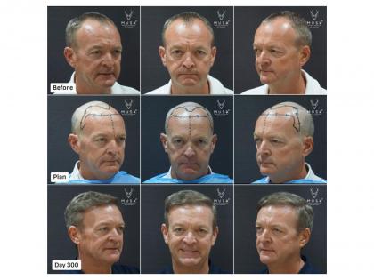 India's Medical Tourism Boom: How Musk Clinic is Shaping the Global Aesthetics & Hair Restoration Demand | India's Medical Tourism Boom: How Musk Clinic is Shaping the Global Aesthetics & Hair Restoration Demand India's Medical Tourism Boom: How Musk Clinic is Shaping the Global Aesthetics & Hair Restoration Demand | India's Medical Tourism Boom: How Musk Clinic is Shaping the Global Aesthetics & Hair Restoration Demand