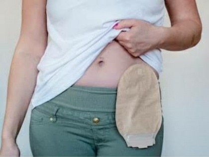 Medical experts believe that a digitally connected ecosystem will improve the quality of life for Ostomates | Medical experts believe that a digitally connected ecosystem will improve the quality of life for Ostomates