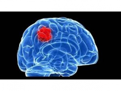 New drug targets for lethal brain cancer discovered | New drug targets for lethal brain cancer discovered