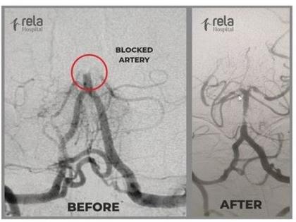 Mechanical Thrombectomy - a treatment of choice for acute ischemic stroke | Mechanical Thrombectomy - a treatment of choice for acute ischemic stroke Mechanical Thrombectomy - a treatment of choice for acute ischemic stroke | Mechanical Thrombectomy - a treatment of choice for acute ischemic stroke