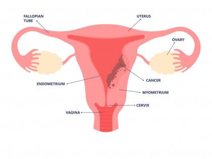 Testosterone shows promise to treat endometrial cancer: Study | Testosterone shows promise to treat endometrial cancer: Study Testosterone shows promise to treat endometrial cancer: Study | Testosterone shows promise to treat endometrial cancer: Study
