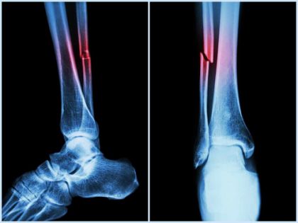 Can AI help patients with bone fractures? | Can AI help patients with bone fractures?
