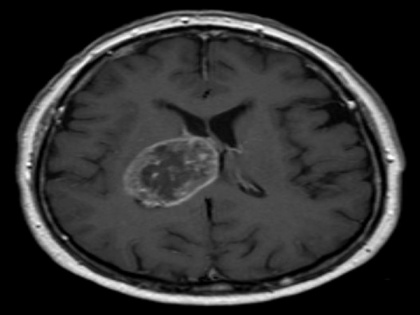 Study highlights importance of routinely imaging brain tumour patients | Study highlights importance of routinely imaging brain tumour patients