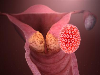 Cervical cancer survival may improve by targeting senescent 'zombie' cells | Cervical cancer survival may improve by targeting senescent 'zombie' cells Cervical cancer survival may improve by targeting senescent 'zombie' cells | Cervical cancer survival may improve by targeting senescent 'zombie' cells