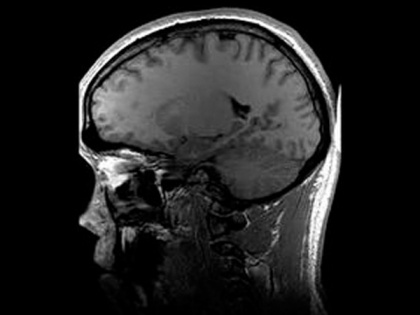 Study links increase in delirium, rare brain inflammation and stroke to COVID-19 | Study links increase in delirium, rare brain inflammation and stroke to COVID-19
