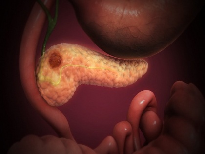 Study focuses on improving survival in pancreatic cancer | Study focuses on improving survival in pancreatic cancer
