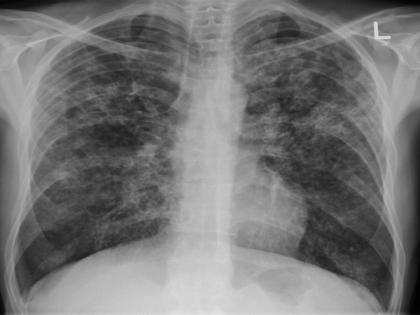 Study suggests body clock associated with development of pulmonary fibrosis | Study suggests body clock associated with development of pulmonary fibrosis