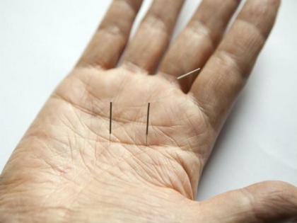 Study reveals acupuncture can reduce migraine headaches | Study reveals acupuncture can reduce migraine headaches