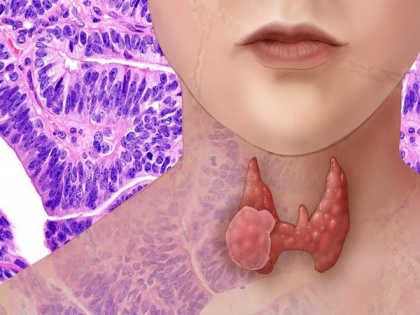 Study finds COVID-19 can cause atypical thyroid inflammation | Study finds COVID-19 can cause atypical thyroid inflammation