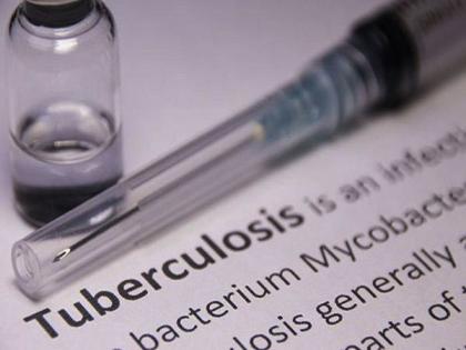 Study finds tuberculosis can induce premature cellular ageing | Study finds tuberculosis can induce premature cellular ageing
