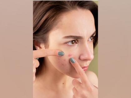Study of genetics discovers new acne risk genes, provides hope for new treatment | Study of genetics discovers new acne risk genes, provides hope for new treatment