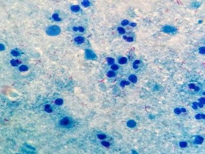 Ghana declares first outbreak of deadly Marburg virus | Ghana declares first outbreak of deadly Marburg virus Ghana declares first outbreak of deadly Marburg virus | Ghana declares first outbreak of deadly Marburg virus