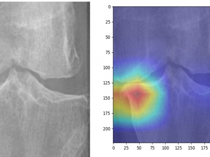 IIT Guwahati's AI model to predict knee osteoarthritis severity from X-rays | IIT Guwahati's AI model to predict knee osteoarthritis severity from X-rays