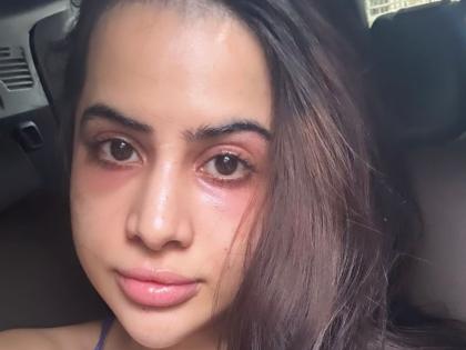 Uorfi's under eye fillers go wrong: 'Why did I do this to myself' | Uorfi's under eye fillers go wrong: 'Why did I do this to myself' Uorfi's under eye fillers go wrong: 'Why did I do this to myself' | Uorfi's under eye fillers go wrong: 'Why did I do this to myself'