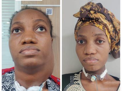 Doctors remove musk melon-sized tumour from Nigerian woman's neck | Doctors remove musk melon-sized tumour from Nigerian woman's neck