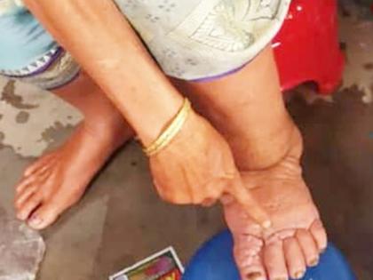 UP to launch triple drug therapy to counter filariasis | UP to launch triple drug therapy to counter filariasis UP to launch triple drug therapy to counter filariasis | UP to launch triple drug therapy to counter filariasis