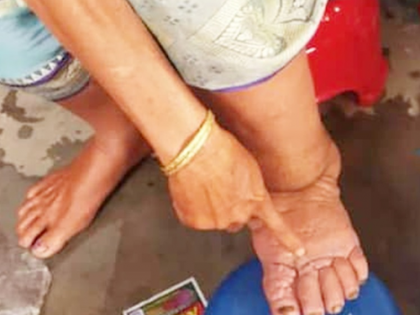 Yogi govt gears up to eradicate filariasis from UP | Yogi govt gears up to eradicate filariasis from UP Yogi govt gears up to eradicate filariasis from UP | Yogi govt gears up to eradicate filariasis from UP