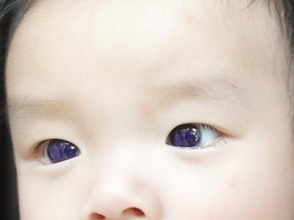 Covid antiviral turns Thai baby's brown eyes blue | Covid antiviral turns Thai baby's brown eyes blue Covid antiviral turns Thai baby's brown eyes blue | Covid antiviral turns Thai baby's brown eyes blue